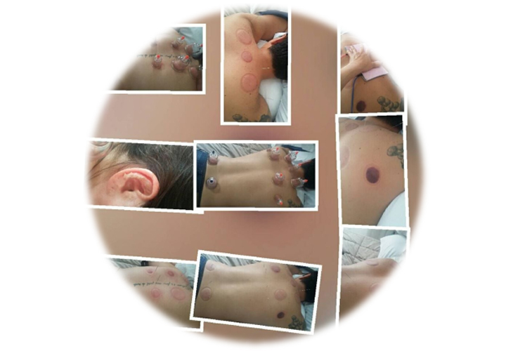 Acupuntura & Ventosaterapia